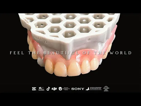 High Quality Removable Metal Framework Denture