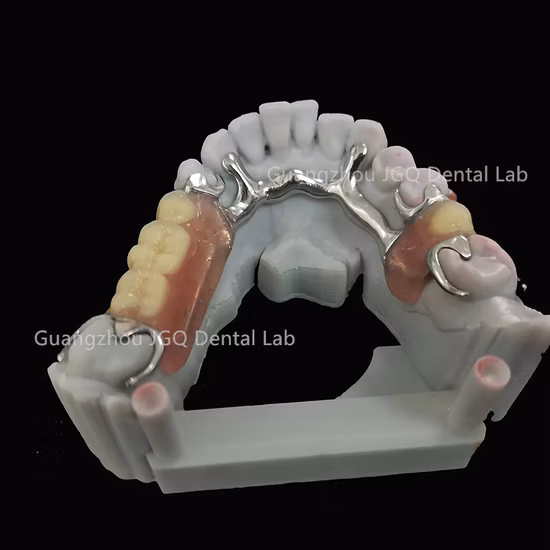 High Quality Removable Metal Framework Denture