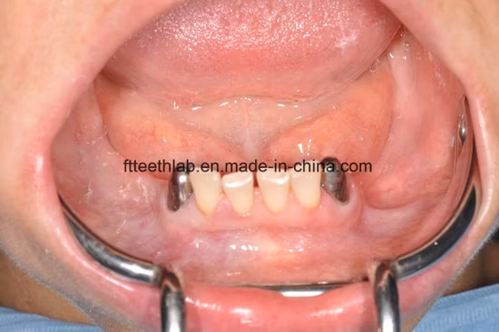 Prothèses partielles en métal moulé avec télescope amovible, fabriquées en laboratoire dentaire en Chine