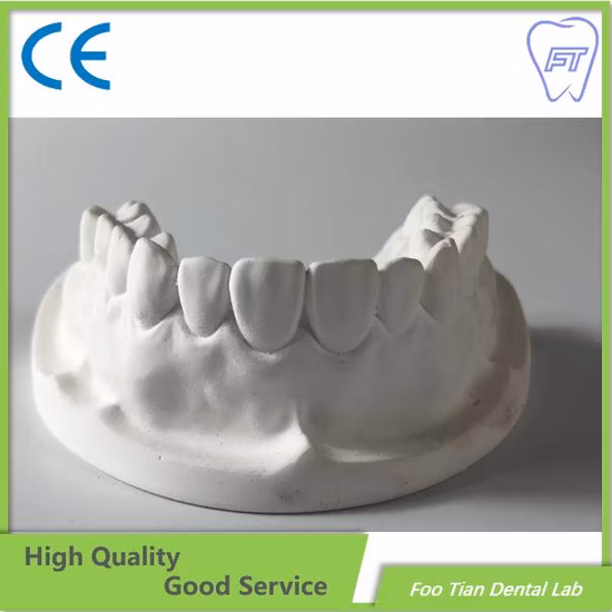 Modèle d'étude d'orthodontie d'implant dentaire, prothèse amovible