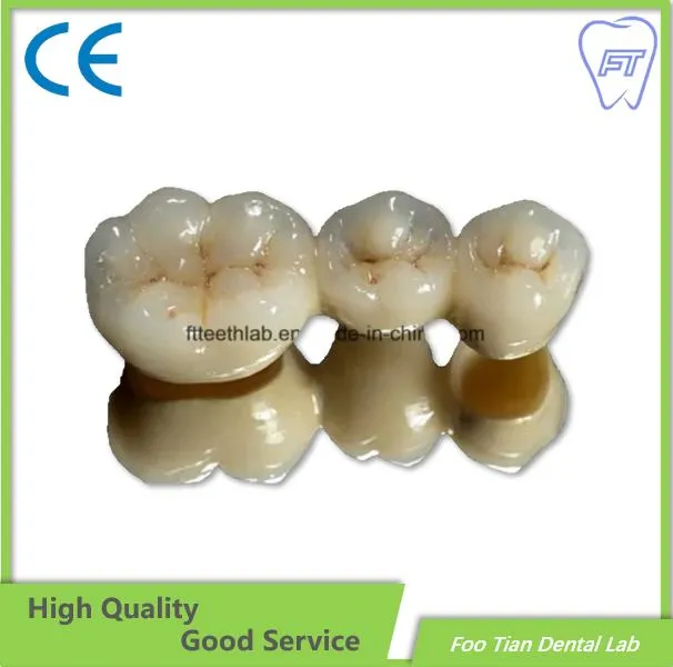 Couronne dentaire en métal et céramique pour restauration fixe, fabriquée dans le laboratoire dentaire Foo Tian à Shenzhen en Chine