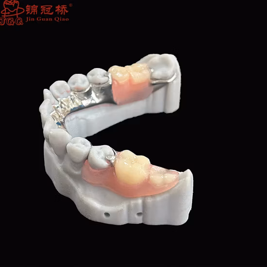 Prothèse à armature métallique amovible de haute qualité