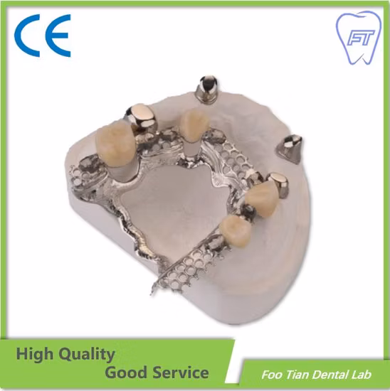 Modèle d'étude d'orthodontie de haute qualité, prothèse amovible